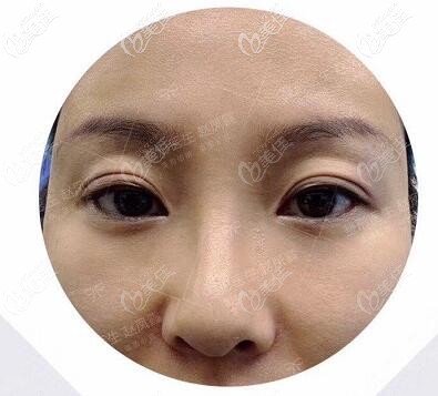 眼修复术前照 眼修复术前照