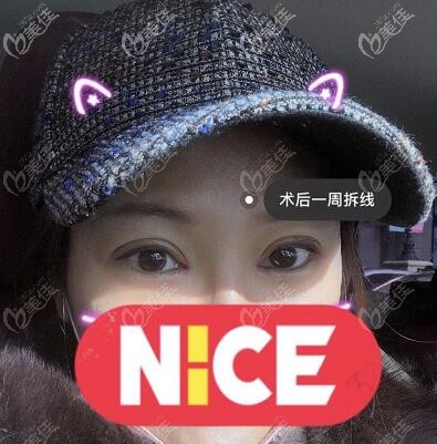 眼综合修复术后一周拆线 眼综合修复术后一周拆线