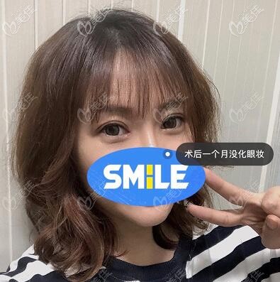 眼修复术后一个月照 眼修复术后一个月照