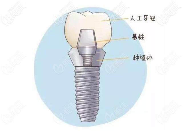 种植牙结构示意图