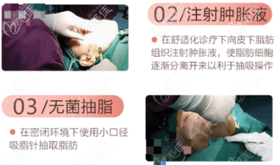 王俊河医生做自体脂肪面部填充的技术优势一 王俊河医生做自体脂肪面部填充的技术优势一