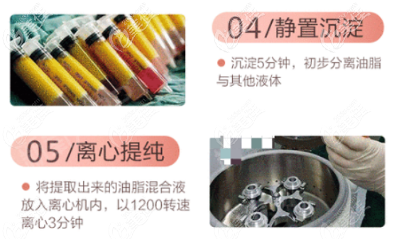 王俊河医生面部脂肪填充怎么样？结合案例和技术分析其实蛮不错的