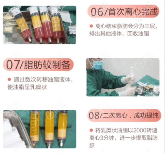 王俊河医生做自体脂肪面部填充的技术优势三 王俊河医生做自体脂肪面部填充的技术优势三