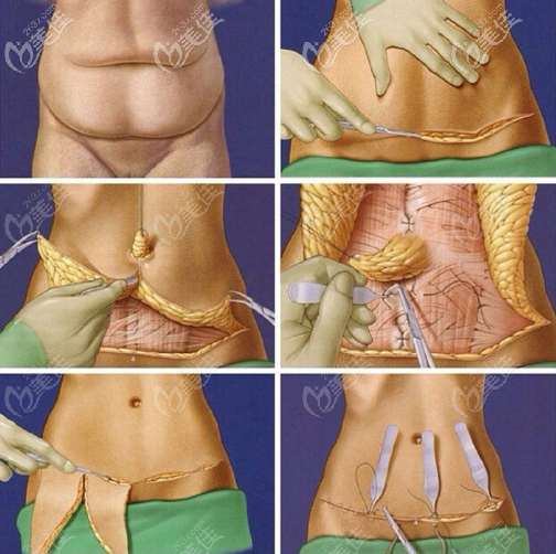腹壁整形术手术过程图解