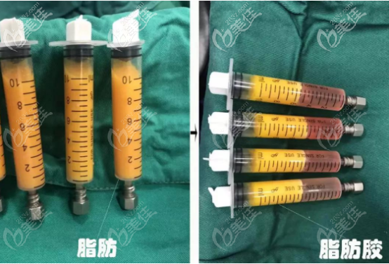 svf脂肪胶和普通脂肪的对比