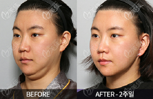 韩国Liting整形外科面部提升去双下巴<span style= 韩国Liting整形外科面部提升去双下巴<span style=