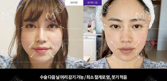 韩国Liting整形外科面部小拉皮手术<span style= 韩国Liting整形外科面部小拉皮手术<span style=