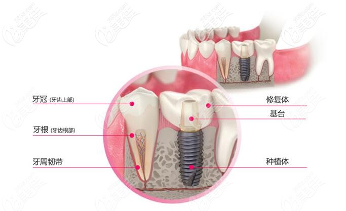 韩国dio种植体新出的UF型号