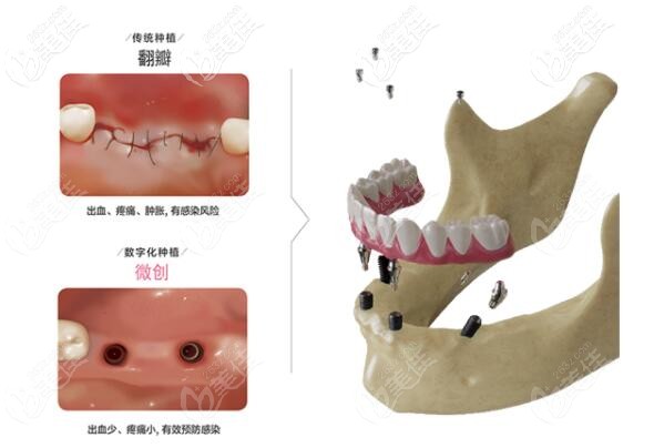 dio数字化种植系统