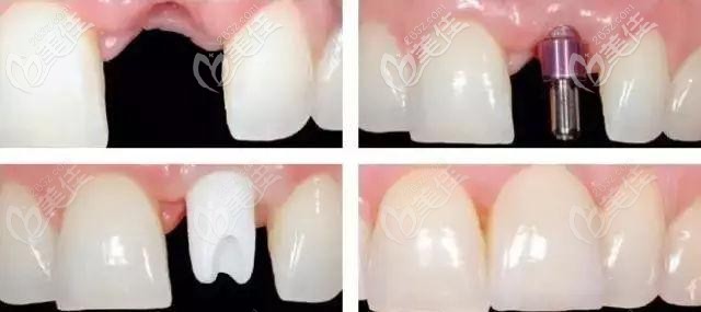 前门牙种植修复