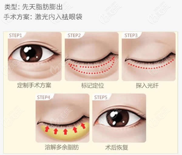 刘强医生做激光祛眼袋手术过程图 刘强医生做激光祛眼袋手术过程图