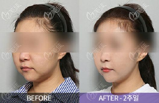 权泳勋迷你切开面部提升<span style=