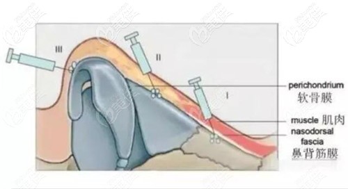 防止葡聚糖隆鼻后鼻子变宽的注射技巧