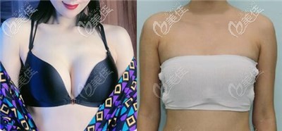 黄名斗做的傲诺拉隆胸60天疗效对比图