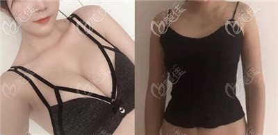 黄名斗做的曼托250cc假体隆胸术后半年疗效