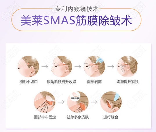 武汉美莱专有内窥镜筋膜除皱技术