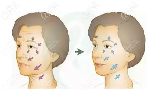 大拉皮面部除皱前后对比照片