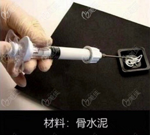 韩国爱婷填充后脑勺用的骨水泥