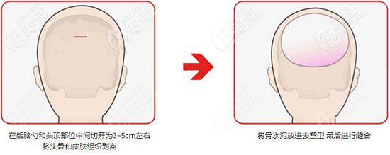韩国爱婷骨水泥填充后脑勺切口