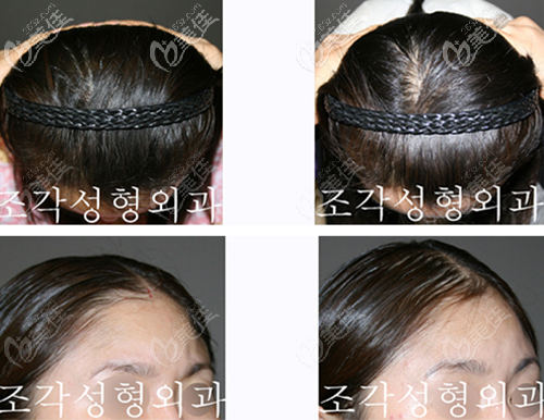 韩国爱婷骨水泥填充后脑勺案例