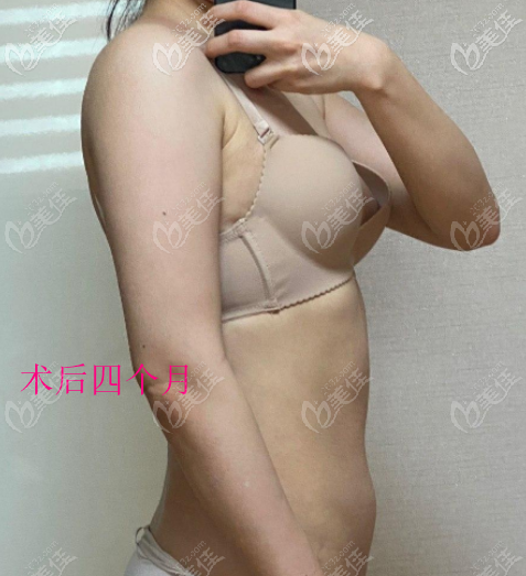 我两侧手臂吸脂600CC能瘦2厘米变细一圈，并且一直没有反弹