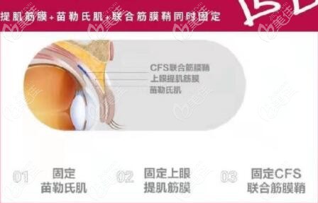 韩国原辰CFS重度眼睑下垂矫正术