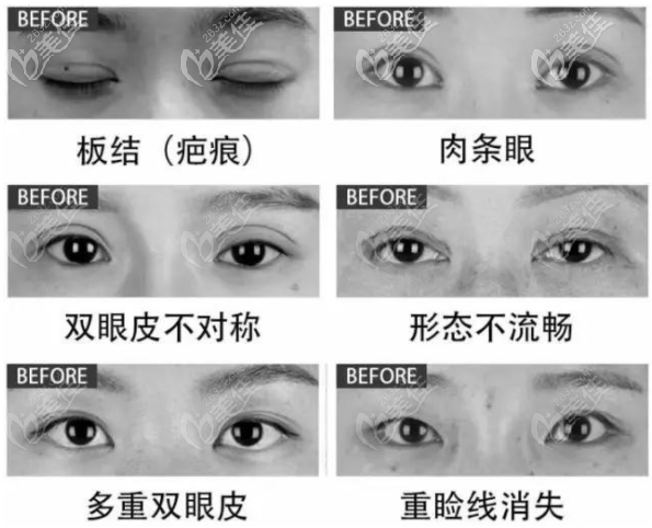 双眼皮早期修复有哪些症状