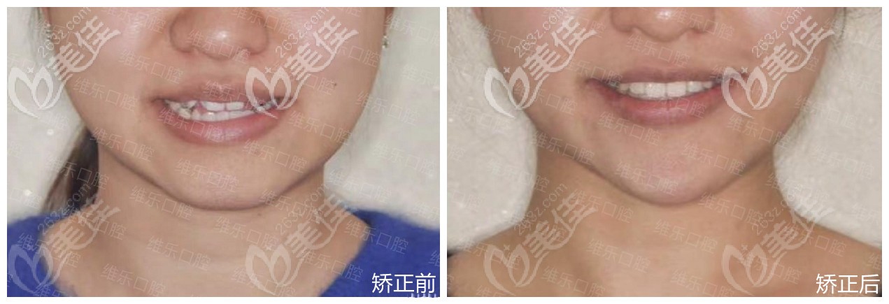 福州维乐家的正畸案例 福州维乐家的正畸案例