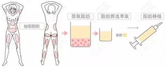 南京自体脂肪隆胸注射几次？