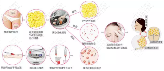 南京艺星自体脂肪隆胸技术优势