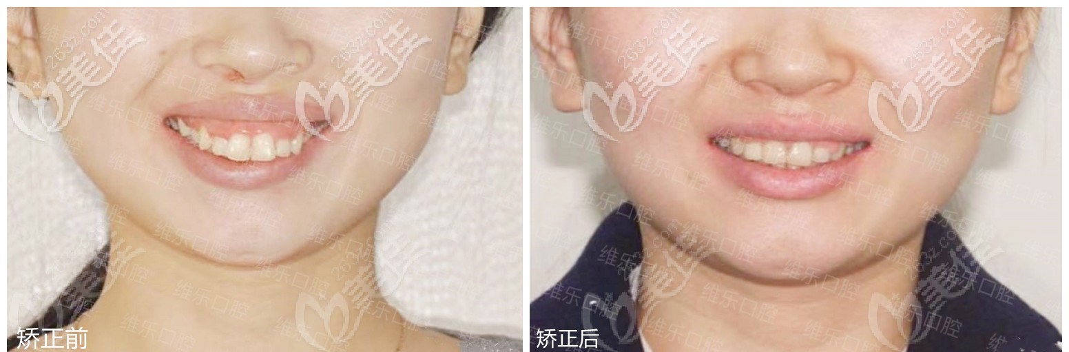 正畸前后对比图 正畸前后对比图