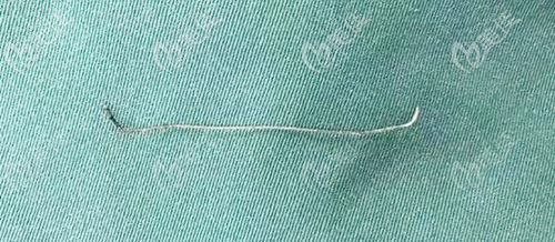 埋线提升的线材弯曲、不平整 埋线提升的线材弯曲、不平整