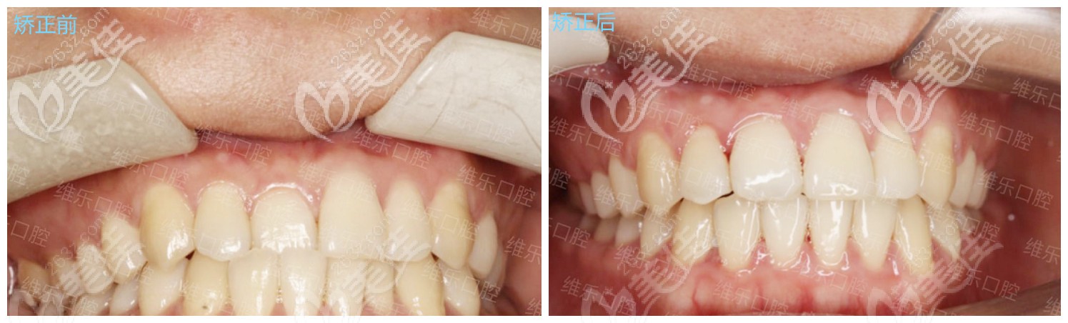 陈先生在福州维乐矫正后的效果 陈先生在福州维乐矫正后的效果