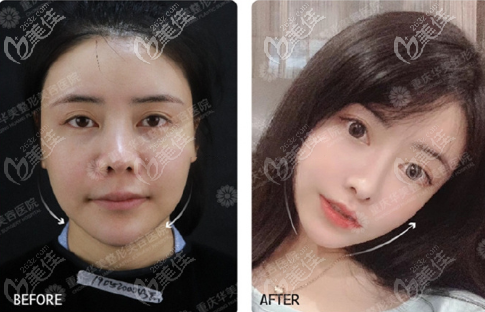 重庆华美青春脸部埋线提升案例对比照片