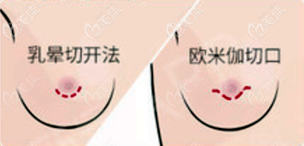 欧米伽隐形微创切口