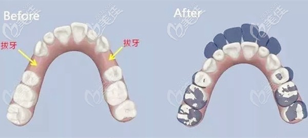 正畸拔牙前和关闭牙缝后的效果