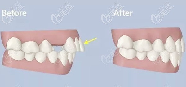 拔牙正畸收缝前后效果图