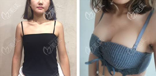 深圳军科刘月更医生300cc傲诺拉璀璨隆胸图