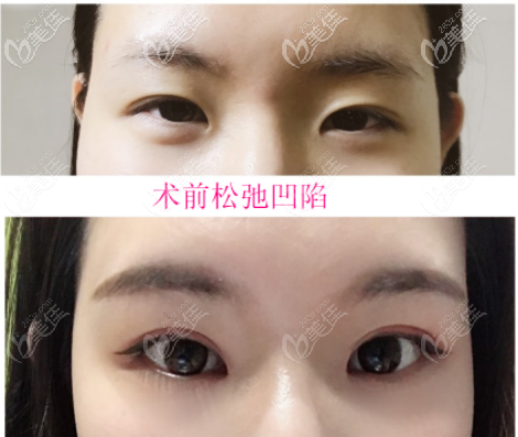 上眼皮松弛凹陷做的窄的开扇型双眼皮案例一 上眼皮松弛凹陷做的窄的开扇型双眼皮案例一