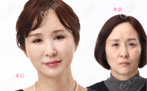 上眼皮松弛凹陷做的窄的开扇型双眼皮案例三 上眼皮松弛凹陷做的窄的开扇型双眼皮案例三