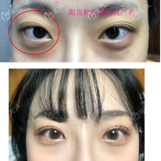 上眼皮松弛凹陷做的窄的开扇型双眼皮案例四 上眼皮松弛凹陷做的窄的开扇型双眼皮案例四