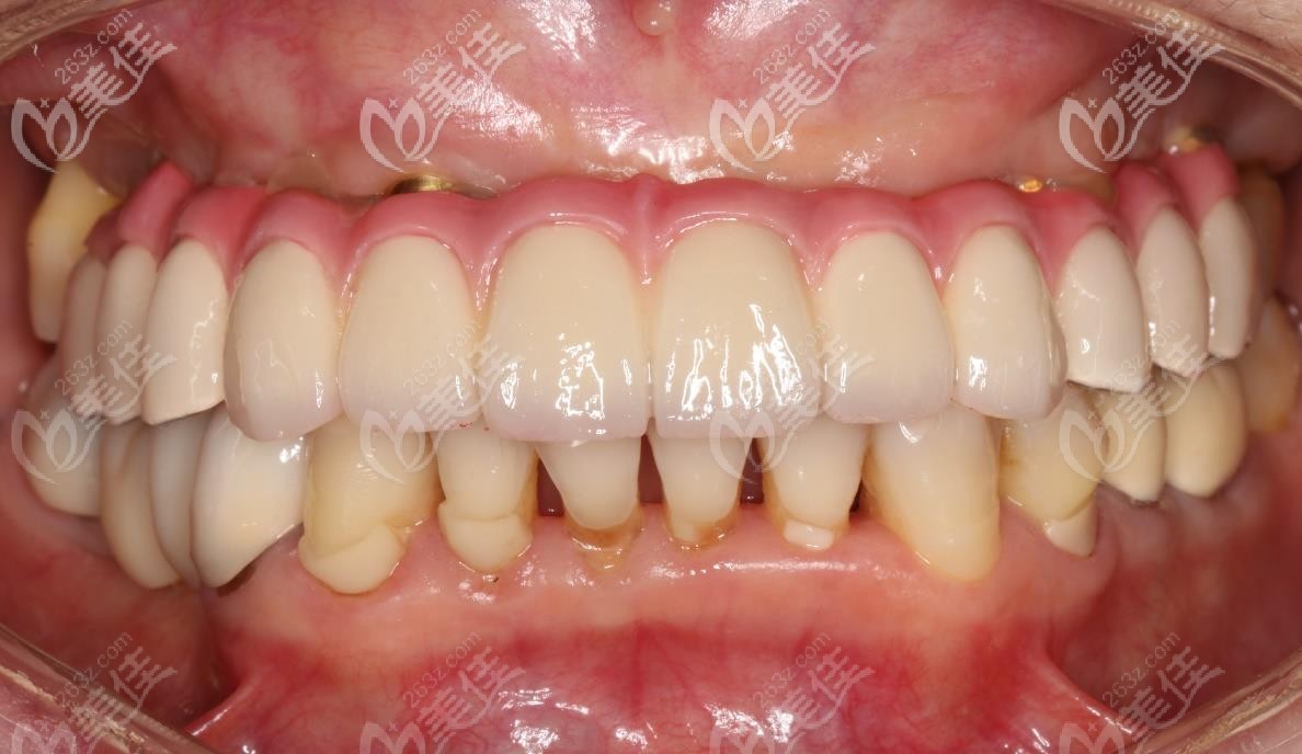 64岁阿姨上颌半口牙齿缺失,用allon6即刻负重技术修复了满口牙