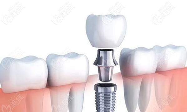 瑞士ITI种植系统