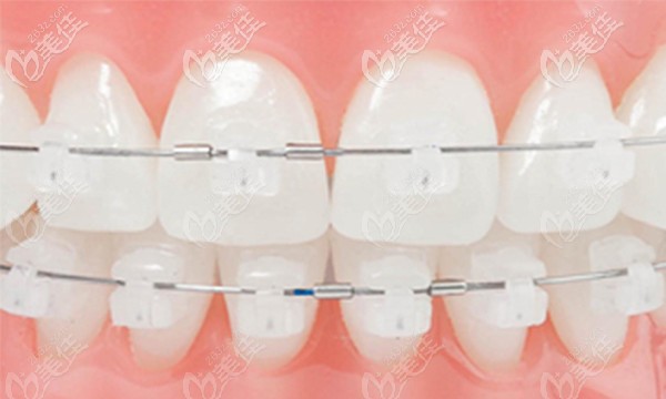 唯格口腔牙齿矫正费用