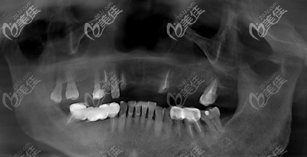 半口牙缺失CT 半口牙缺失CT