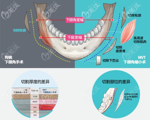 传统下颌角手术与韩国ID整形医院MVT下颌角对比