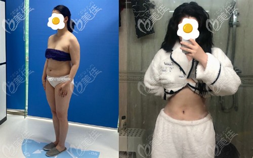深圳艺星腰腹吸脂案例 深圳艺星腰腹吸脂案例