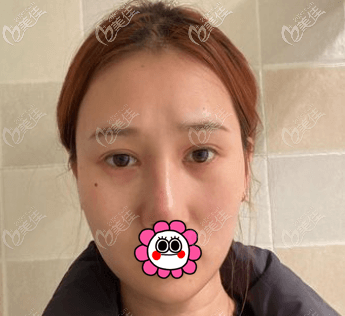 邢志花医生给我做热玛吉前样子 邢志花医生给我做热玛吉前样子