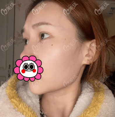 做热玛吉眼部除皱第8天了 做热玛吉眼部除皱第8天了