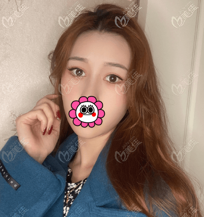 热玛吉对眼纹多久有效果?我做完2月左右效果就明显了 热玛吉对眼纹多久有效果?我做完2月左右效果就明显了